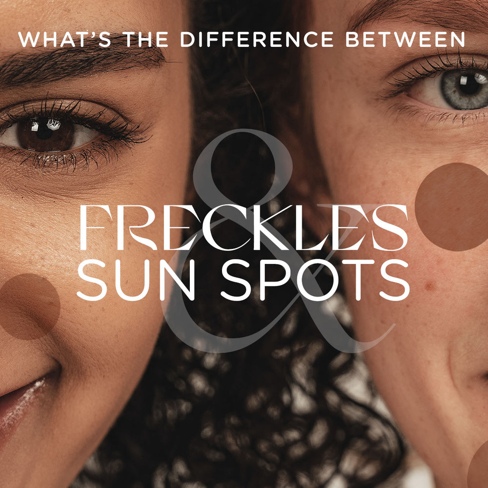 The difference between freckles and sun spots