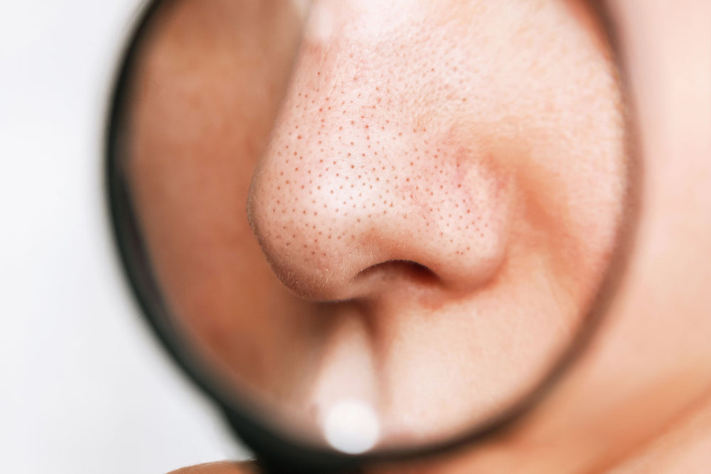 PORES NO MORE! ARE YOU SUFFERING FROM POREXIA?